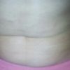 Liposukcja: niezadowolona z efektu :/ czy tak to ma wyglądać?