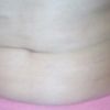 Liposukcja: niezadowolona z efektu :/ czy tak to ma wyglądać?