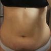 Liposukcja strzykawkowa 