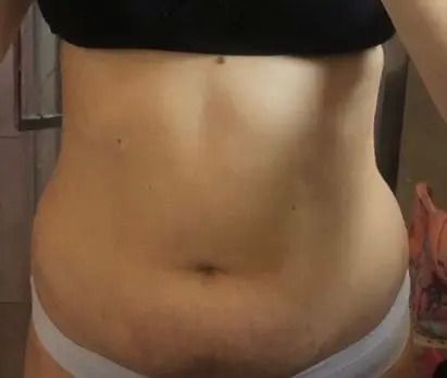 Liposukcja strzykawkowa 