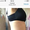 Liposukcja strzykawkowa 