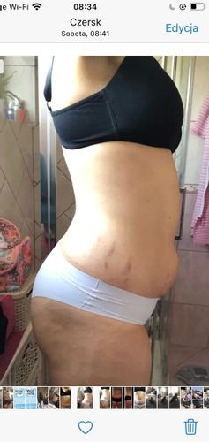 Liposukcja strzykawkowa 