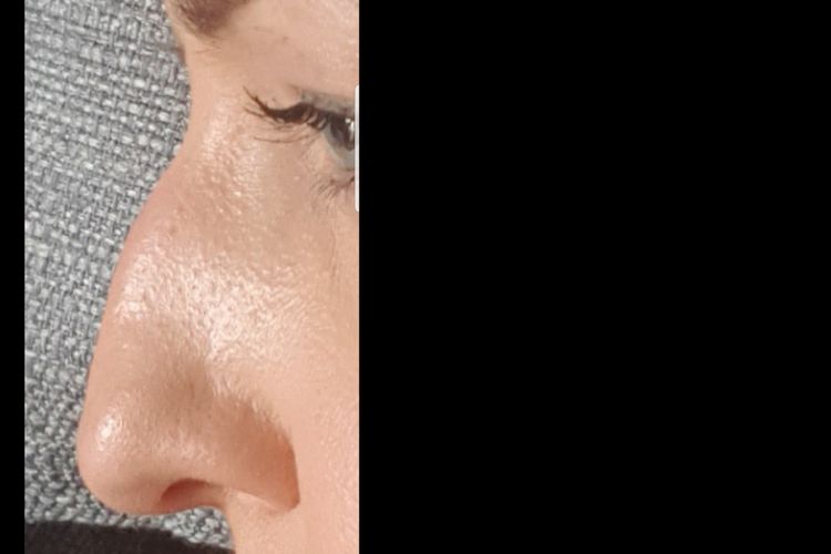 Alergiczny Nieżyt Nosa I Korekta Nosa Kwasem Estheticonpl 5164
