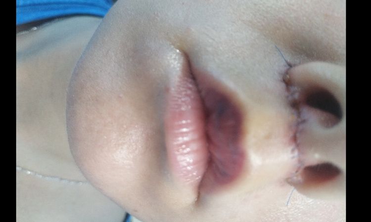 Lip lift - czy blizna dobrze się goi? - 12496