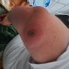 Wypalony naczyniak laserem klasy IV