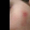 Blizna po zabiegu laserem frakcyjnym co2
