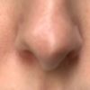 Asymetria czubka nosa po operacji - 15599