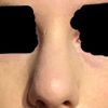 Gruba skóra na nosie a korekta nosa chrzęstnego - 15604
