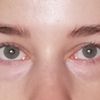 Czy mezoterapia preparatem Dermaheal Eyebag Solution usunie worki pod oczami?