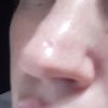 Wgłębienie na nosie po zabiegu laserowym - 16063