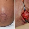 Sagittal Crest Reduction - Redukcja grzebienia strzałkowatego
