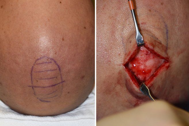 Sagittal Crest Reduction - Redukcja grzebienia strzałkowatego