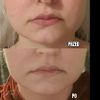 Najskuteczniejsze metody wyszczuplania twarzy - 16380