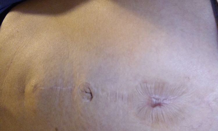 Czy komplikacje po abdominoplastyce mogą się powtórzyć przy korekcie? - 16462