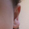 Plastyka małżowin - odstająca dolna część ucha - 16634