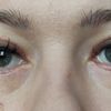Niezadowalający efekt blepharoplastyki - worki pod oczami - 16736