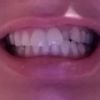 Korona na cofnietego zęba - 16816