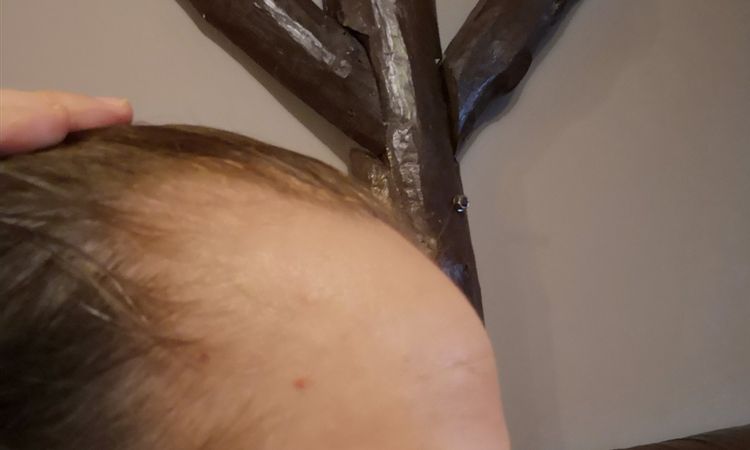 Zakola i przeszczep włosów u kobiety - 25239