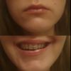 Opadające kąciki ust i niesymetryczny uśmiech spowodowane tyłozgryzem - 32670