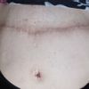Peeling chemiczny na bliznę po cesarskim cięciu