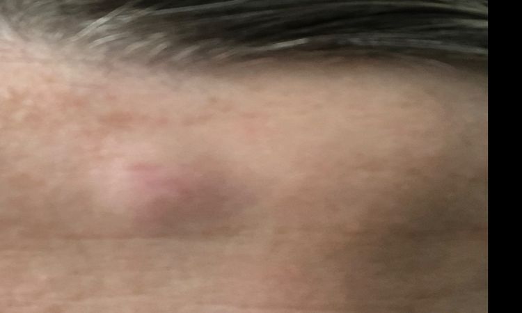 Powiększający się guzek na czole - 33484