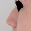 Czy w przypadku garbatego nosa można zrobić jedynie korektę części kostnej? - 41866