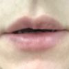 Krzywe usta tydzień po powiększaniu kwasem Neauvia - 42406