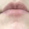Krzywe usta tydzień po powiększaniu kwasem Neauvia - 42407