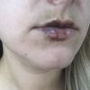 Krzywe usta tydzień po powiększaniu kwasem Neauvia - 42408