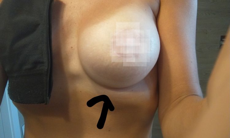 Fałdka pod piersią, uczucie opadnięcia - 42570