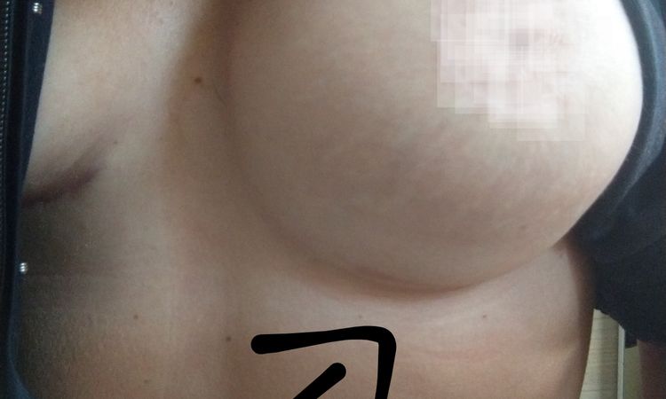 Fałdka pod piersią, uczucie opadnięcia - 42571