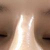 Korekta nosa kwasem hialuronowym (nos krzywy z przodu) - 42641