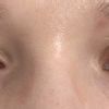 Asymetria oczu, opadająca powieka - 42680