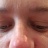 Opuchlizna nosa po wstrzyknięciu kwasu hialuronowego