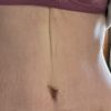 Pionowe wgłębienie po abdominoplastyce