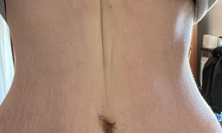 Pionowe wgłębienie po abdominoplastyce - 45057