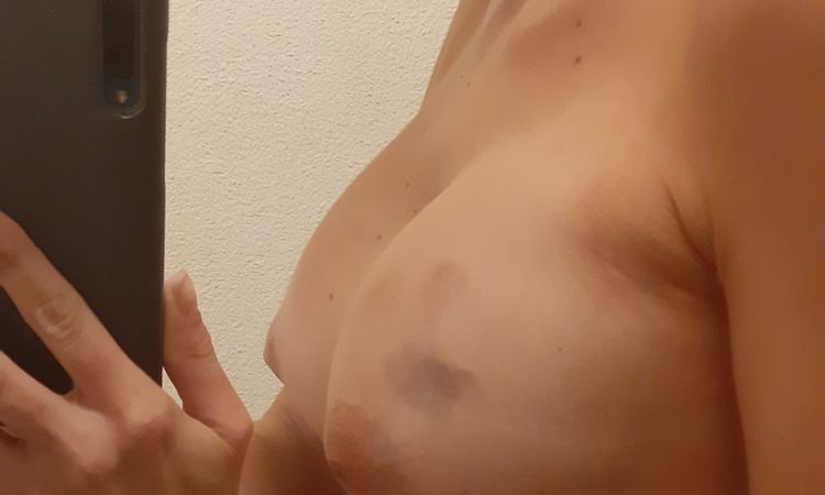 Sutki skierowane do dołu 7 dni po operacji - 45616