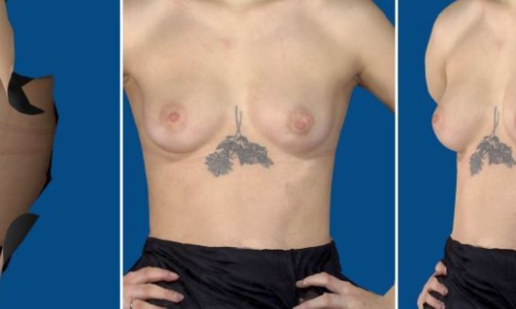 Pytanie o profil implantu - 47177