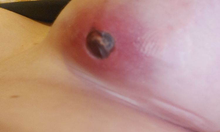 Usuniecie implantów piersi - 48699