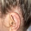 6 tygodni po korekcie odstających uszu - ból i wypukła blizna - 48711