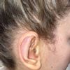 6 tygodni po korekcie odstających uszu - ból i wypukła blizna