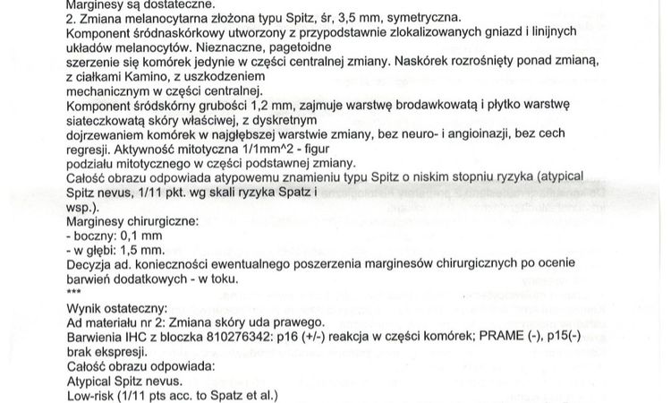 Usuniete nowopowstale znamie zdiagnozowane jako Spitz - 48764