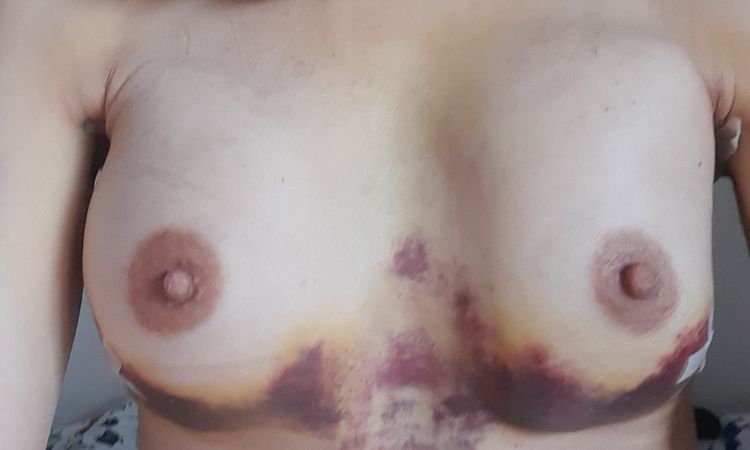 Do jakiego czasu po operacji piersi mogą być nierówne? - 50303