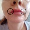 Czy normalne jest powstawanie wałeczka przy ustach po podaniu wypełnienia?