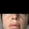 Czy efekt zniekształconych ust po powiększaniu zniknie? - 50820
