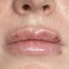 Czy efekt zniekształconych ust po powiększaniu zniknie? - 50822