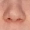 Duży nos po operacji