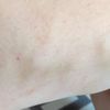 Czy efekt po ablacji żylaków powinien być natychmiastowy?