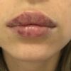 Czy to normalny proces gojenia ust? - 53301