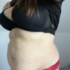 Jaka operacja przywróci estetyczny wygląd brzucha po ciąży i cc? - 53723